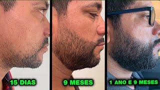 ELE USOU MINOXIDIL aos 38 ANOS evolução minoxidil [upl. by Rufena733]