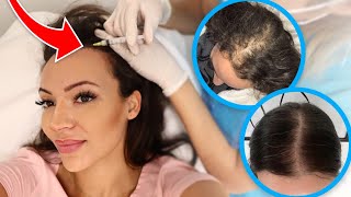 PRP for Hair Loss my PRP THERAPY journey [upl. by Orfield]