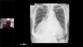 Radiologia do Tórax parte 2 Cardiologia [upl. by Hairabez464]