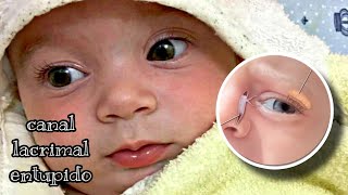 Como desobstruir canal lacrimal em bebê bebê canallacrimalentupido olhos [upl. by Dawn356]