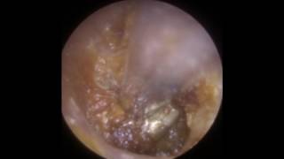 Attempted Endoscopic Removal of Ear Wax Embedded on Eardrum  Mr Neel Raithatha The Hear Clinic [upl. by Wiatt140]