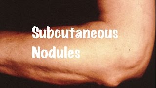 Brief information on Subcutaneous Nodules [upl. by Raeann466]