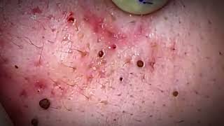 Extreme Blackhead Removal Ever 2024 [upl. by Notsreik]