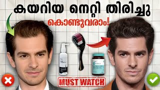 Receding hairline Re Grow your hair In 2 Methods Malayalam 🔱🔥 [upl. by Coady504]