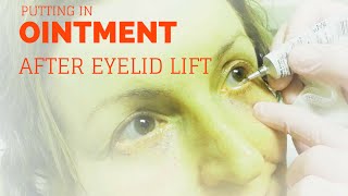 Putting ointment in your eyes after lower blepharoplasty [upl. by Mccallion]