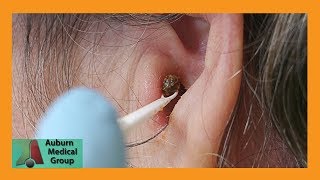 Chunky Earwax Removal  Auburn Medical Group [upl. by Nahsad]