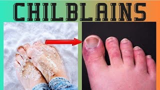 Chilblains causes symptoms treatment urduhindi [upl. by Ellinnet]