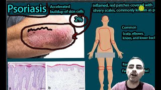 Psoriasis Symptoms types and treatment [upl. by Torie917]