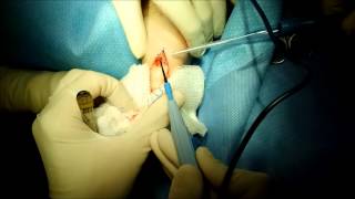 Large Wart on Foot surgical excision [upl. by Etnuahc]