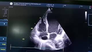 Good CaseSevere hypokinesia and aneurysm of LV apex with suspicion of clot Mild TR Chiari network [upl. by Wil]