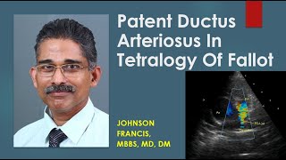 Patent Ductus Arteriosus In Tetralogy Of Fallot [upl. by Encratia]