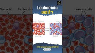 What is Leukemia  Leukemia in hindi  Symptoms of Leukemia  Treatment Leukemia shorts [upl. by Labaw]