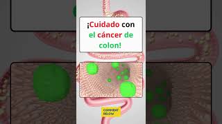 🚨¡CUIDADO SI TIENES UNO DE ESTOS SIGNOS PUEDES TENER CÁNCER DE COLON [upl. by Theobald]