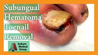 Subungual Hematoma Blood Clot Under Nail Removal  Auburn Medical Group [upl. by Sidnee]