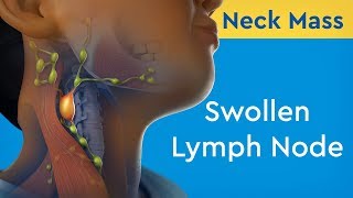 Neck Mass Swollen Lymph Node [upl. by Nolan]