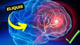 Eliquis The Revolutionary Anticoagulant for Stroke and Blood Clot Prevention [upl. by Laikeze]