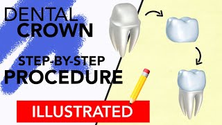 Dental Crown StepByStep Procedure Illustrated [upl. by Nancy]