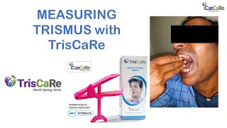 Measuring and Grading Trismus with TrisCaRe Dr Pawan Gupta ICanCaRe [upl. by Bunow]