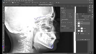 Cephalometrics Part 2 المرحلة الخامسة [upl. by Nayr806]