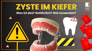 Zyste im Kiefer  Was ist das Entstehung Therapie und Folgen  Carree Dental Köln [upl. by Farris]