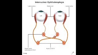 Cause of Opthalmoplegia  Lesion to 3rd 4th 6th cranial nerve [upl. by Kcyrred]