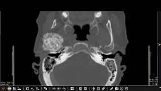 Tumoral calcinosis [upl. by Ammon]