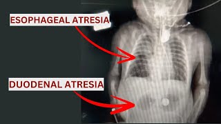 Esophageal Atresia amp Duodenal Atresia Qida borusu və Onikibarmaq bağırsaq Atreziyası [upl. by Doane]