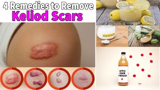 Keloid Scar Removal at Home 4 Remedies for Treatment of Scars [upl. by Euqenimod725]