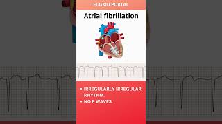 Atrial Fibrillation Anatomy ECG icu medicine emergencymedicine atrialfibrillation [upl. by Kciremed]