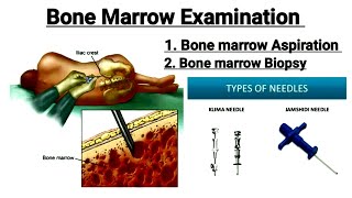 Bone Marrow Examination  Bone marrow Aspiration  Bone marrow biopsy in hindi [upl. by Kristel]