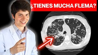 TODO sobre BRONQUIECTASIAS ► FISIOPATOLOGÍA y SÍNTOMAS en 11 MINUTOS MÍRALO 😉 [upl. by Faust791]