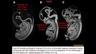 23 Posterior fossa  introductionoverview pontocerebellar hypoplasia Dandy Walker Blakes pouch [upl. by Hayila]