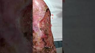 Venous stasis ulceration with pyoderma gangrenosum [upl. by Nidnal]