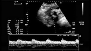 8 weeks fetal heart rate  ultrasound [upl. by Christos853]