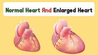 Enlarged Heart Treatment  Enlarged Heart Symptoms  Enlarged Heart enlarge hearttreatment [upl. by Llednav]