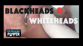 Extracting blackheads and whiteheads around the eyes and cheeks [upl. by Josefa154]