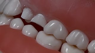 Crown and Bridge premolar preparation [upl. by Domenech604]