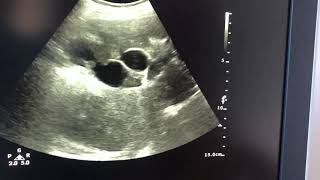 Dilated intrahepatic biliary radicles lab report is uploades in other video [upl. by Ylrebnik]