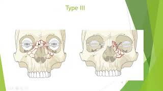 Naso orbito ethmoidal frontal bone and nasal bones fractures dentistryknowledge oralsurgery [upl. by Cathrine]