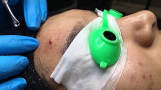 Professional Extractions Facial Lift amp Pump  Blackhead Extraction  Esthetician Training Tutorial [upl. by Stefa]