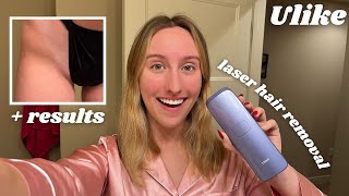 Ulike LASER HAIR REMOVAL Review unboxing and 3 weeks using it [upl. by Hesther62]