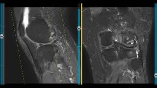 Ill defined bone lesion in tibia [upl. by Bigford955]