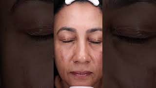 A demonstration of the mesoestetic® mesopeel® melanostop tran3x with Luxe Skin Aesthetics UnboxMe [upl. by Nodaj730]