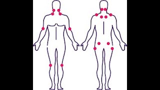 Tender Points Fibromialgia [upl. by Correy150]