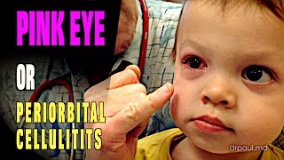 LIVE DIAGNOSIS Pink Eye or Periorbital Cellulitis  Dr Paul [upl. by Zilevi307]