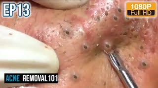 Cystic Acne Extraction 32mn  Blackheads Removal by ACNEREMOVAL101 [upl. by Iidnarb]