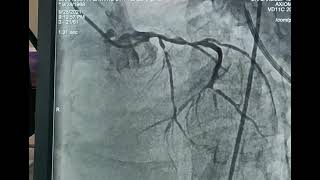 COMPLEX PRIMARY PCI WITH IABP SUPPORT [upl. by Tenay551]