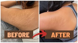 HOW I GOT RID OF MY STRETCH MARKS  NUE CONCEAL NUE CLEAR [upl. by Mosra]