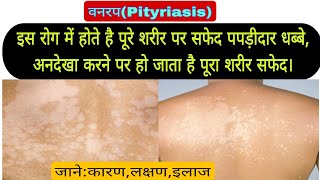 वनरप इस रोग में सफेद धब्बों से निकलती है बारीक पपड़ी Pityriasis versicular karanlakshantreatment [upl. by Anelej]