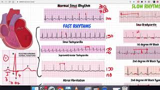 Arrhythmias Made Simple  Quiz Part 2 [upl. by Norga]